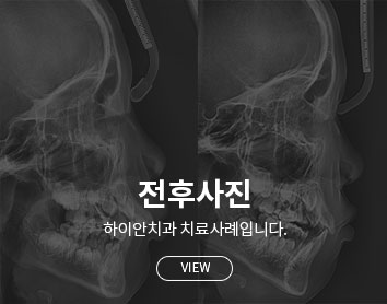 전후사진